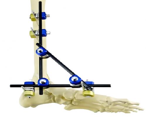 足踝內(nèi)固定系統(tǒng)廠家