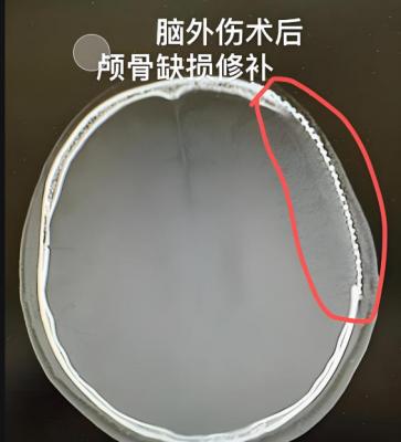 顱骨修補重建系統(tǒng)廠家