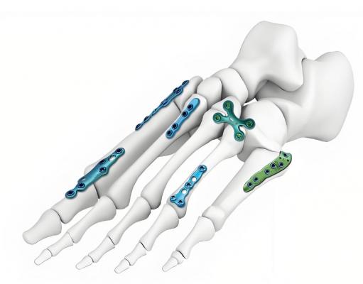 金屬鎖定接骨板系統(tǒng)廠家