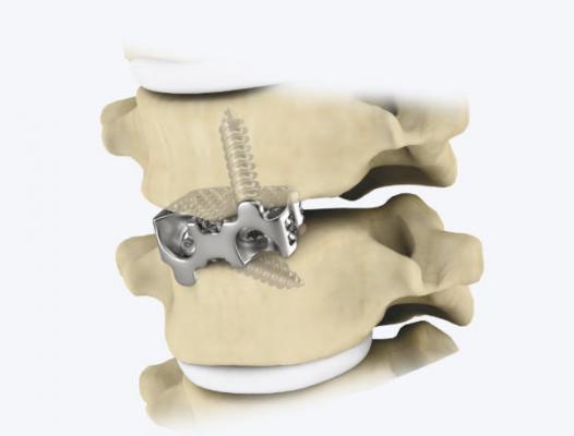 自穩(wěn)定型頸椎椎間融合器 廠家