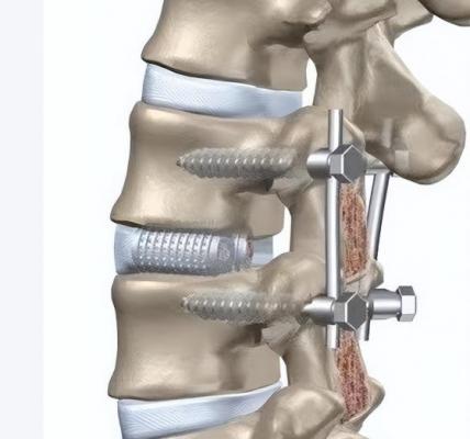 棘突間內(nèi)固定系統(tǒng) 廠家